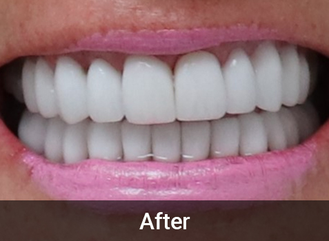 Dental Treatment - Before and After Image