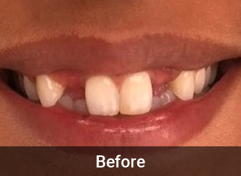 Cosmetic Dentistry Before & After Image