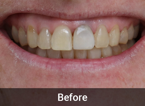 Teeth Whitening - Before & After Image