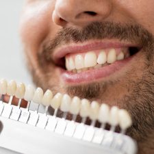 5 Things You Should Know About Veneers