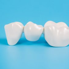 Dental Implants Vs. Bridges: Finding One Suitable for You