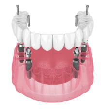 All-on-4 Dental Implants: A Long-Term Solution for Missing Teeth