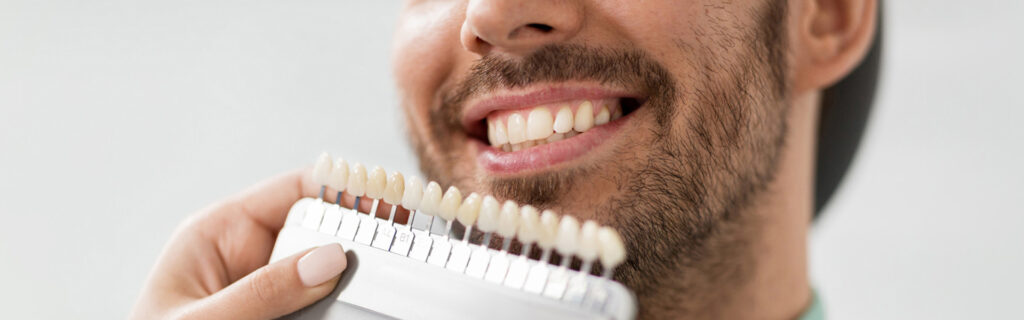 5 Things You Should Know About Veneers
