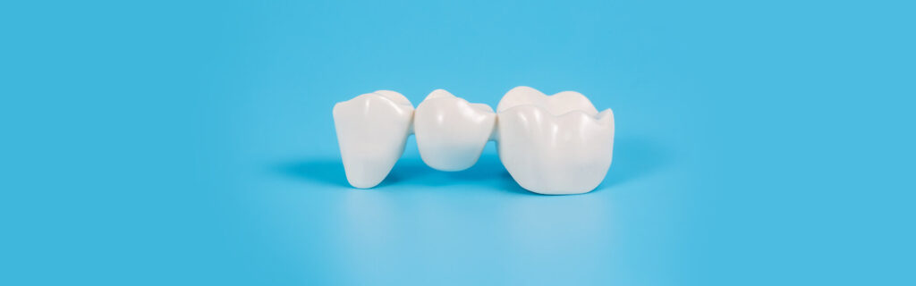 Dental Implants Vs. Bridges: Finding One Suitable for You