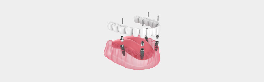 All-on-4 Dental Implants: A Complete Smile Makeover