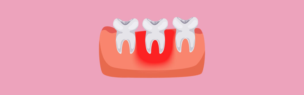 Maintaining Gum Health After Periodontal Treatment: Tips for Long-Term Success